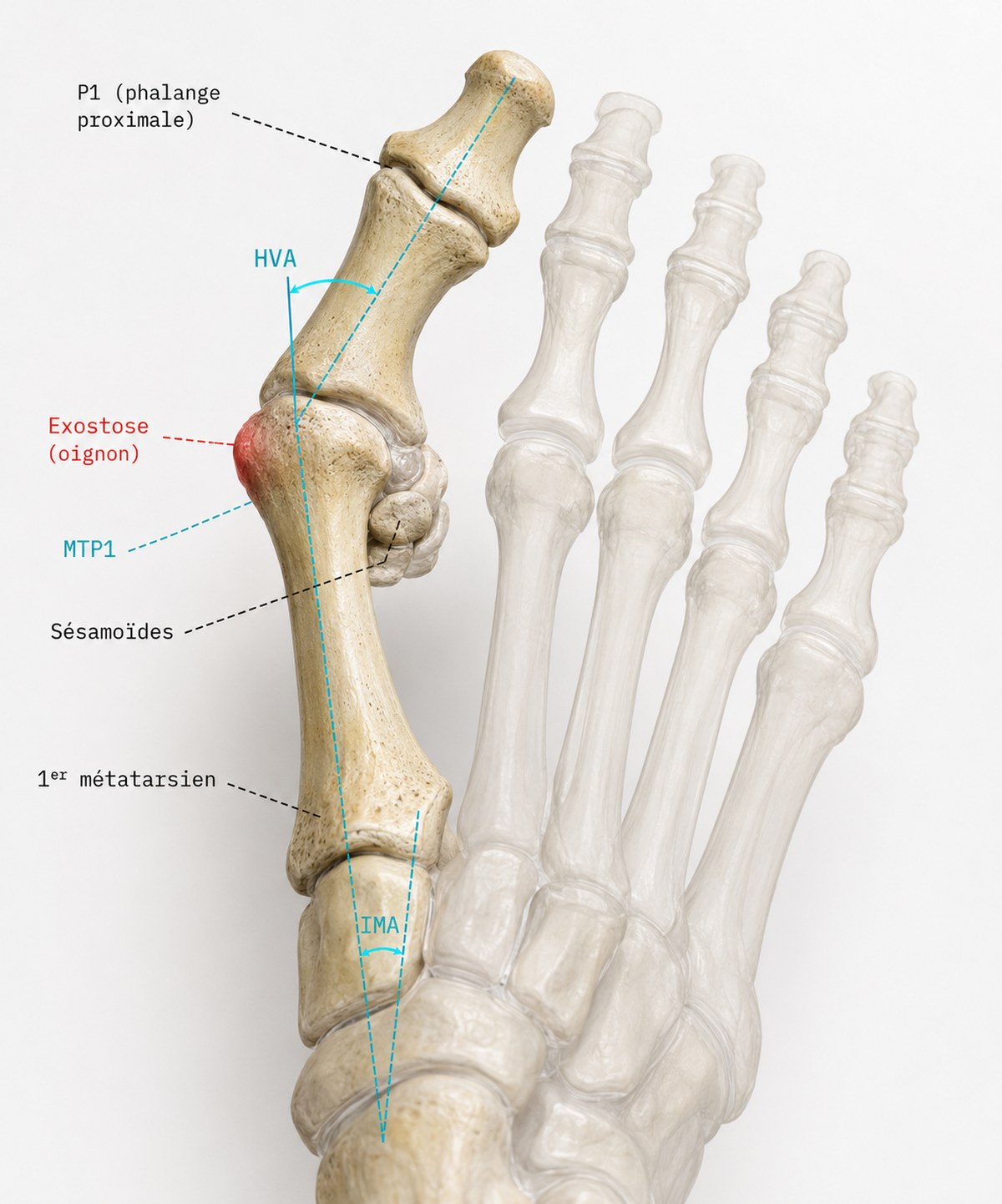 Anatomie 3D de l'hallux valgus  :  P1, HVA, MTP1, sésamoïdes, exostose