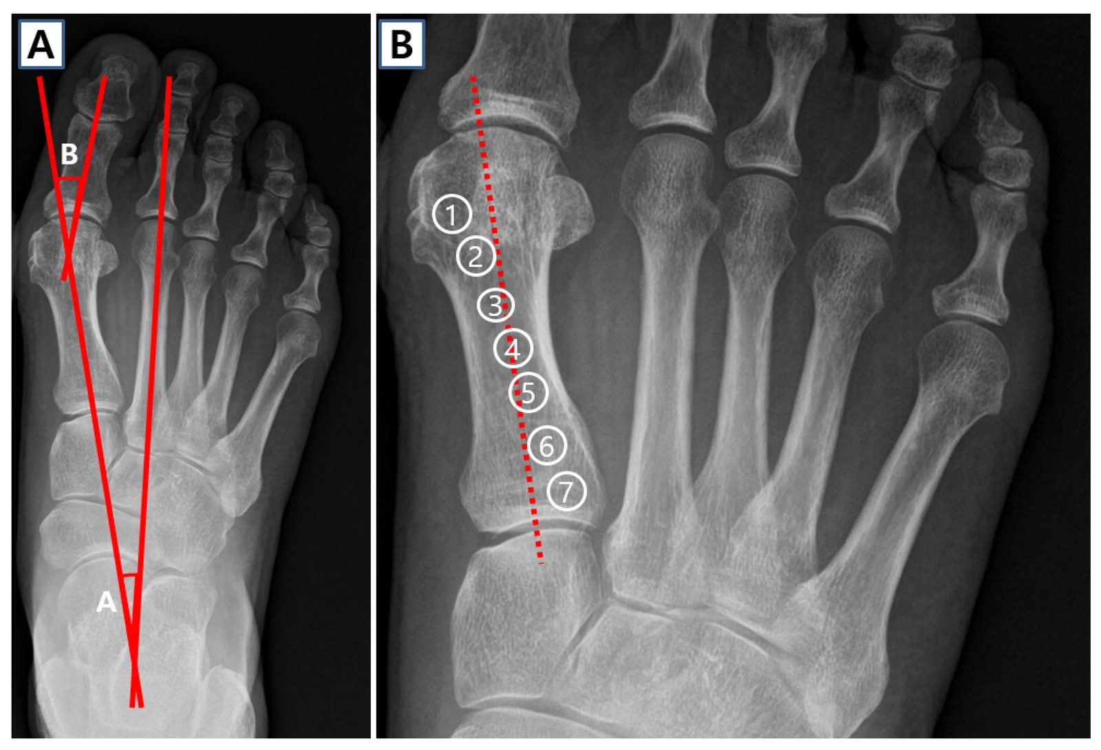 Radiographie AP annotée avec les angles HVA, IMA et DMAA de l'hallux valgus