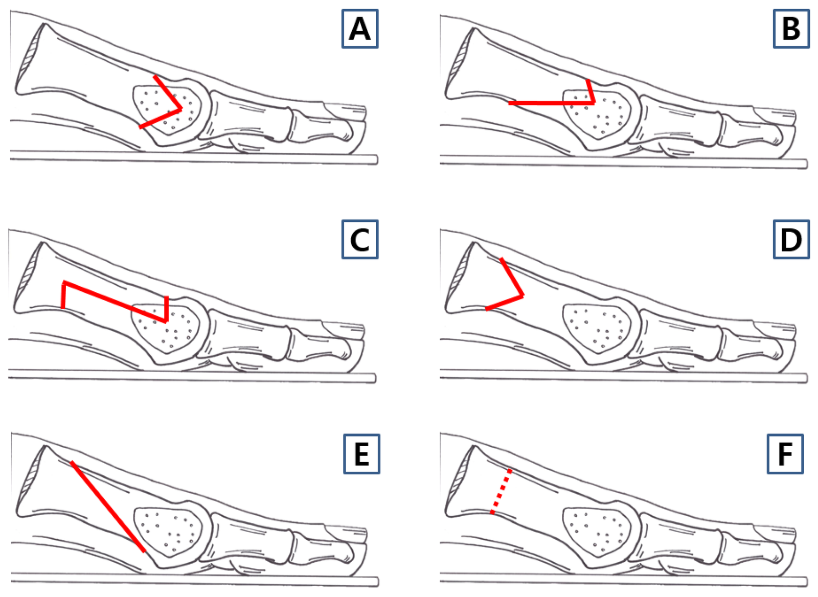 Schémas comparatifs des six techniques d'ostéotomie du premier métatarsien pour l'hallux valgus
