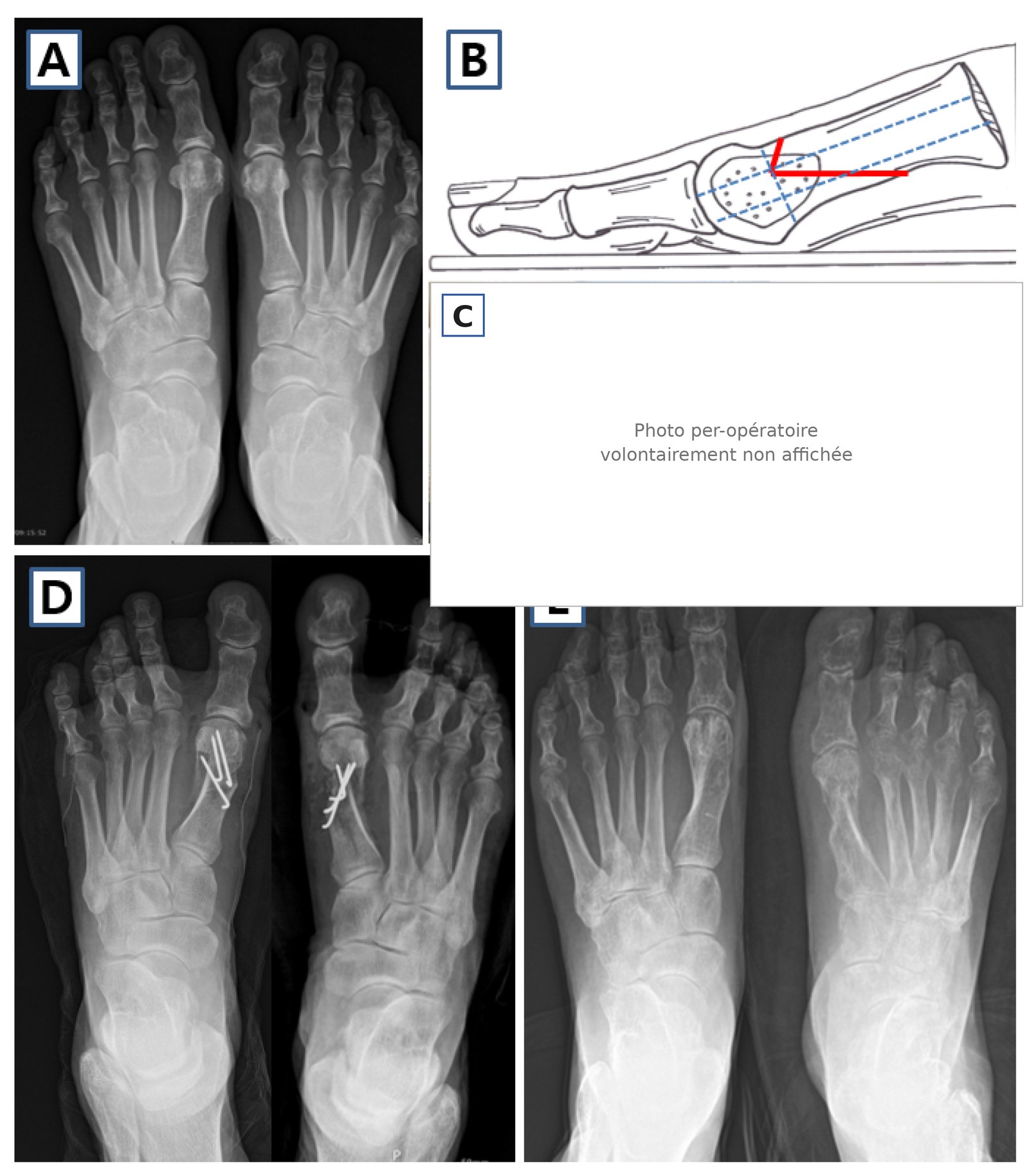 Cas clinique d'ostéotomie de Chevron distal étendue, patiente de 59 ans, radios pré et post-opératoires